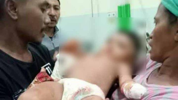 Tangan Balita di Sampang Yang Putus Akibat Mesin Rajang Tembakau Berhasil Disambung Setelah Menjalani Operasi.